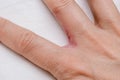 Hand with interdigital dermatitis, dyshidrotic eczema on hand close up Royalty Free Stock Photo