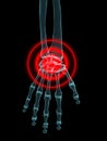 Hand join inflammation