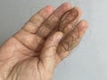 Hand with loss hair, hairloss problem. Hair treatment and therapy concept