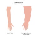 Lymphedema of arm