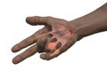 Hand of a male patient with Dupuytren's contracture, photorealistic 3D illustration