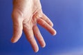 Hand of an man with Dupuytren contracture on blue