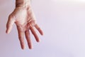 Hand of an man with Dupuytren contracture Royalty Free Stock Photo
