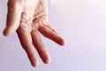 Hand of an man with Dupuytren contracture Royalty Free Stock Photo