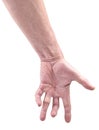 Hand of an man with Dupuytren contracture disease Royalty Free Stock Photo