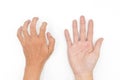 Hand muscle spasm in Asian young man. Unilateral hand deformity. Abnormal fingers flexion Royalty Free Stock Photo