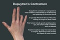 Hand of a patient with Dupuytren's contracture, photorealistic 3D illustration