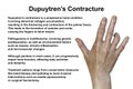 Hand of a patient with Dupuytren's contracture, photorealistic 3D illustration