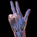 Hand of a patient with Dupuytren's contracture, 3D illustration