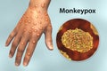 Hand of a patient with monkeypox infection, 3D illustration