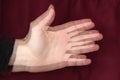 Hand of a person with tremors due to Parkinson`s disease