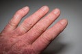 Hand of a psoriasis patient close-up. Psoriatic arthritis. Joint deformation and inflammation on the skin. Photo with dark Royalty Free Stock Photo
