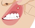 Hand-pull upper lip with aphthae or aphtha close up, illustration cartoon