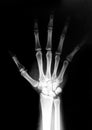 Hand radiograph Royalty Free Stock Photo