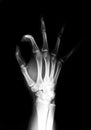 Hand radiograph Royalty Free Stock Photo