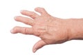 Hand With Rheumatoid Arthritis