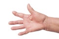 Hand With Rheumatoid Arthritis Royalty Free Stock Photo