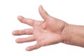 Hand With Rheumatoid Arthritis