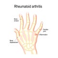 Hand with rheumatoid arthritis