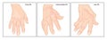 Hand with rheumatoid arthritis Royalty Free Stock Photo