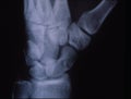 Hand root bone after accident Royalty Free Stock Photo