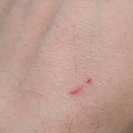 Hand scar Royalty Free Stock Photo