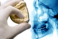 Hand show dental model over x-ray Royalty Free Stock Photo