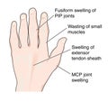 Hand showing arthritic changes