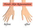 Hand skin rejuvenation, vector illustration isolated on the white background