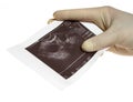 Hand with sonogram