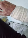 Hand swollen after coronary angiography of vessels, heart
