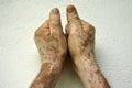 Hand with vitiligo conditions