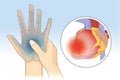 Hand weakness symptom can be caused by heart disease. Royalty Free Stock Photo