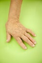 Hand Of Woman Deformed From Rheumatoid Arthritis Royalty Free Stock Photo