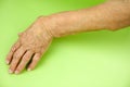 Hand Of Woman Deformed From Rheumatoid Arthritis Royalty Free Stock Photo