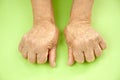 Hand Of Woman Deformed From Rheumatoid Arthritis Royalty Free Stock Photo