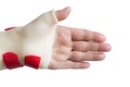 Hand with wrist and thumb splint Royalty Free Stock Photo