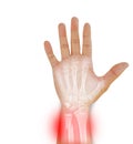 Hand , wrist x-ray view fracture distal ulna pain and swelling ,Medical image concept on white background