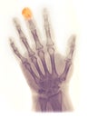 Hand X-ray, fractured/amputated distal phalanx Royalty Free Stock Photo