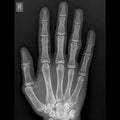 Hand x-ray image ap view Royalty Free Stock Photo