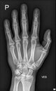 Hand X-Ray Royalty Free Stock Photo