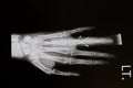 Hand x-rays image Royalty Free Stock Photo