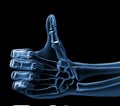 Hand xray