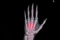 Hand xray showing fractured third and forth metacarpal bones Royalty Free Stock Photo