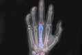 Hand xray showing spiral fractured third metacarpal bone Royalty Free Stock Photo