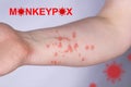 Hand of a young guy in a rash. Monkeypox virus symptoms