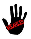 Handprint measles