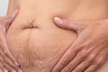 Hands on belly pressed skin to show sagging skin after diet and stretch marks after pregnancy Royalty Free Stock Photo