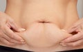 Hands on belly pressed skin to show sagging skin after diet and stretch marks after pregnancy Royalty Free Stock Photo