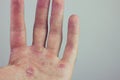 Hands with blister and callus